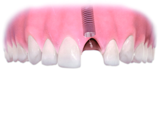 Versorgung Einzelzahnlücke mit Implantat